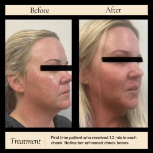 Dermal Fillers