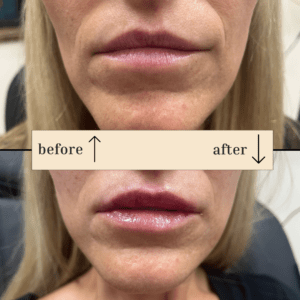 Cosmetic Fillers And Lip Augmentation In Parker, CO