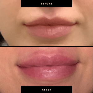 Professional Lip Filler Near Me