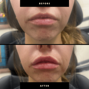 Lip Injections Near Me