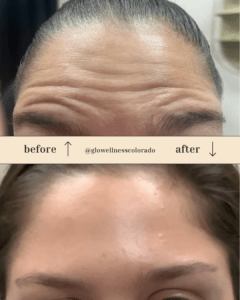 Facial Lines Treatment