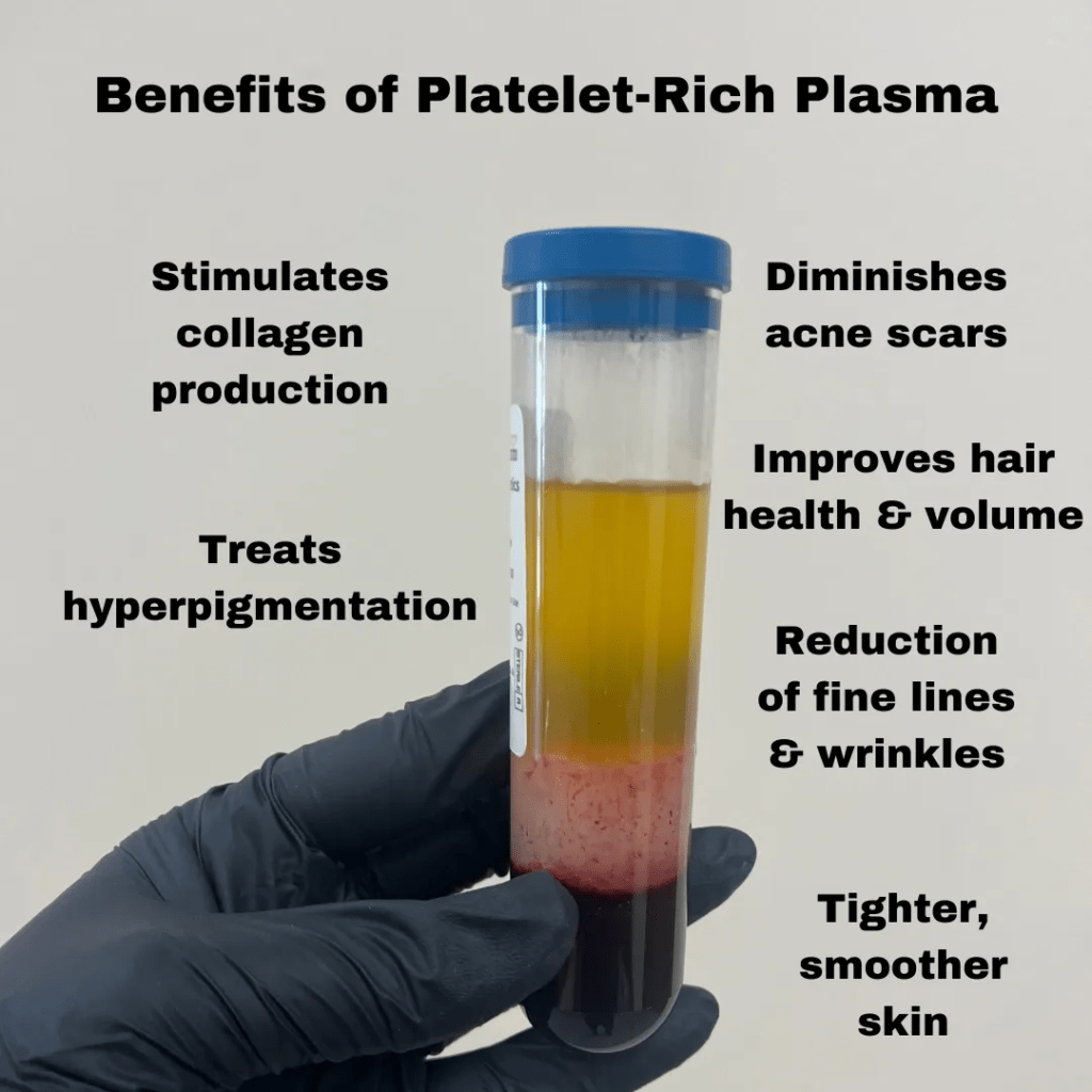 Platelet-Rich-Plasma