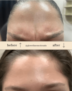 Facial Slimming Injections