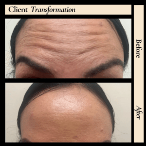 Anti-Aging Injections Near Me