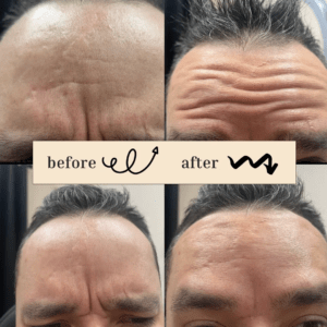 Wrinkle Reduction Treatment