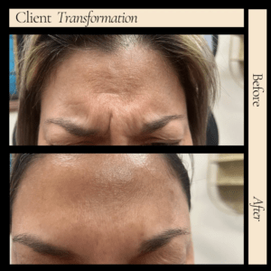 Wrinkle Reduction Near Me