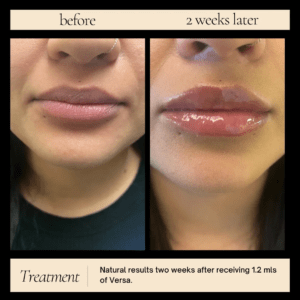 Lip Enhancement Dermal Fillers Near Me