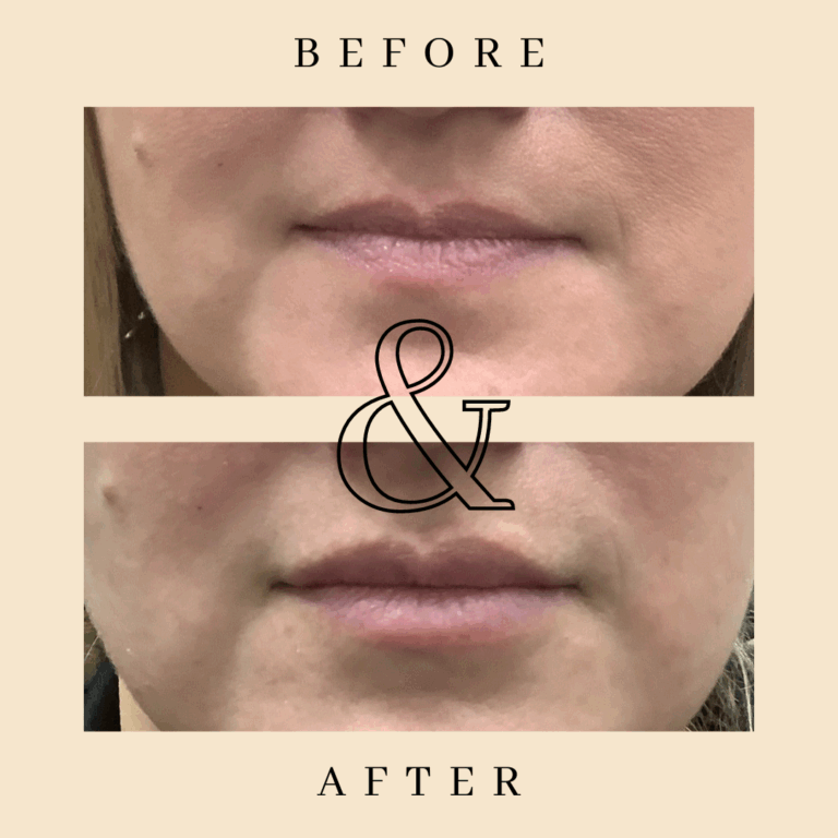 JuneBeforeAfterLips